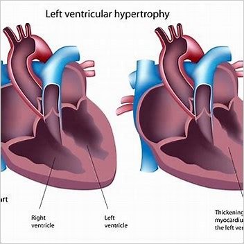 Hypertrophic Cardiomyopathy Autosomal Dominant Disorders