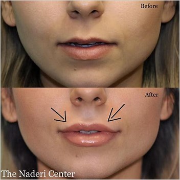 Lip Augmentation Nonsurgical Alternatives